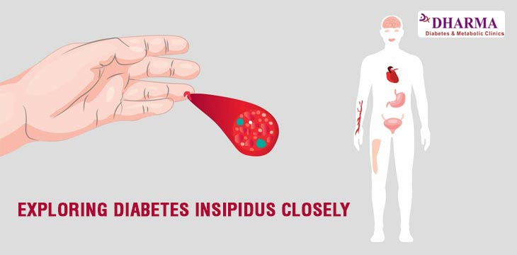 EXPLORING DIABETES INSIPIDUS CLOSELY