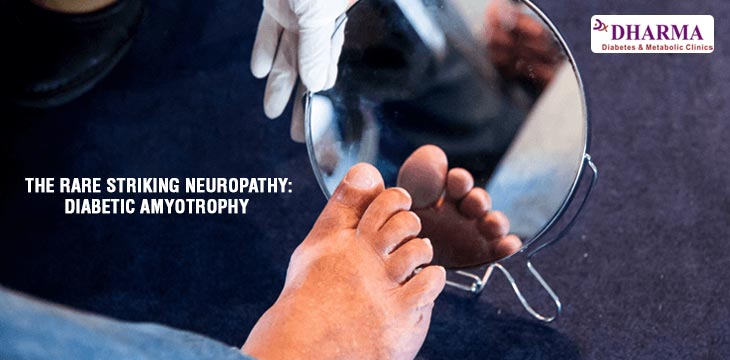 THE RARE STRIKING NEUROPATHY : DIABETIC AMYOTROPHY